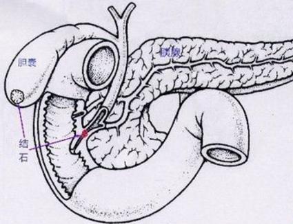 胆结石是什么原因造成的啊,胆结石形成原因3d视频