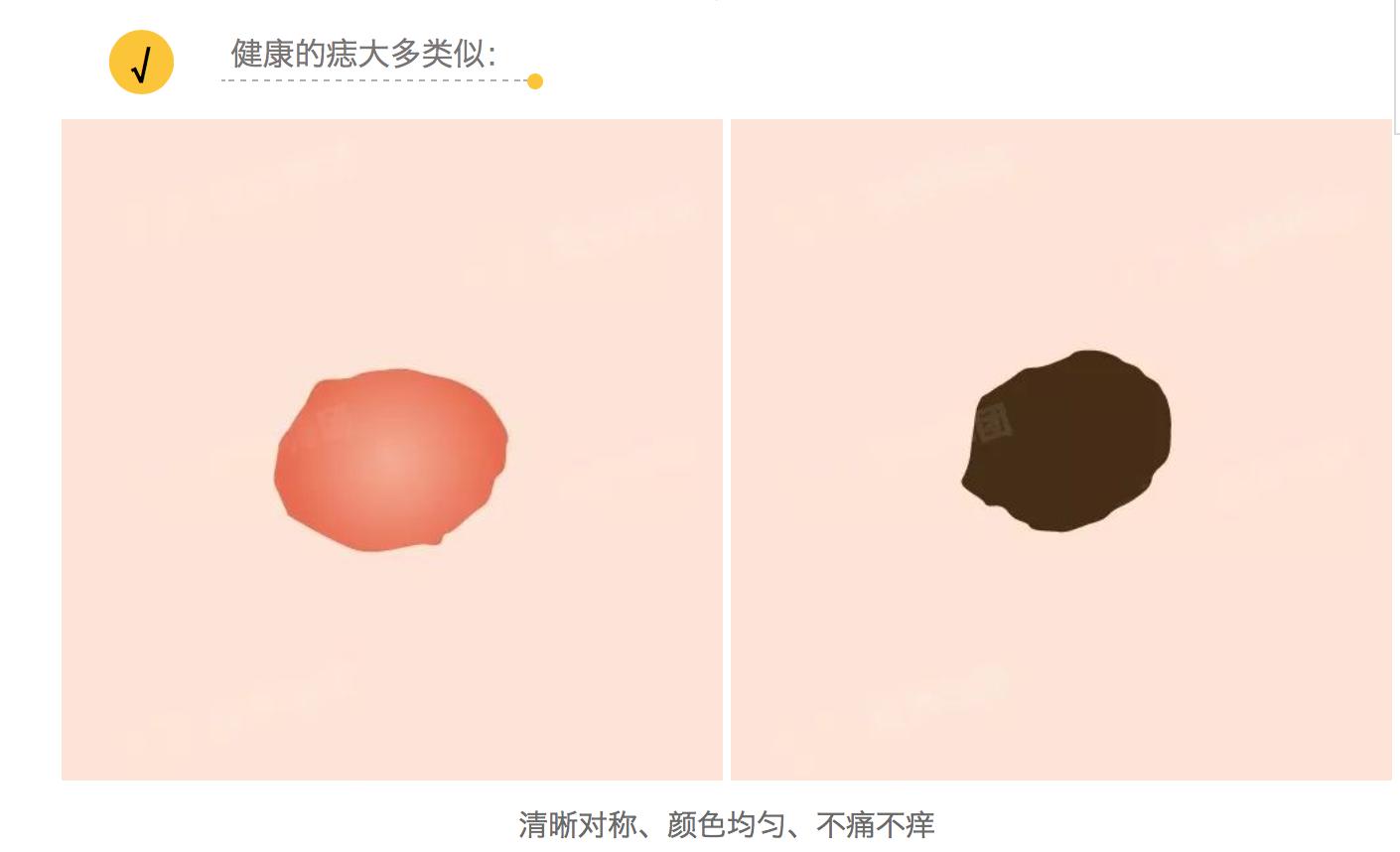 痣未结痂要擦药吗,痣没去干净会有影响吗