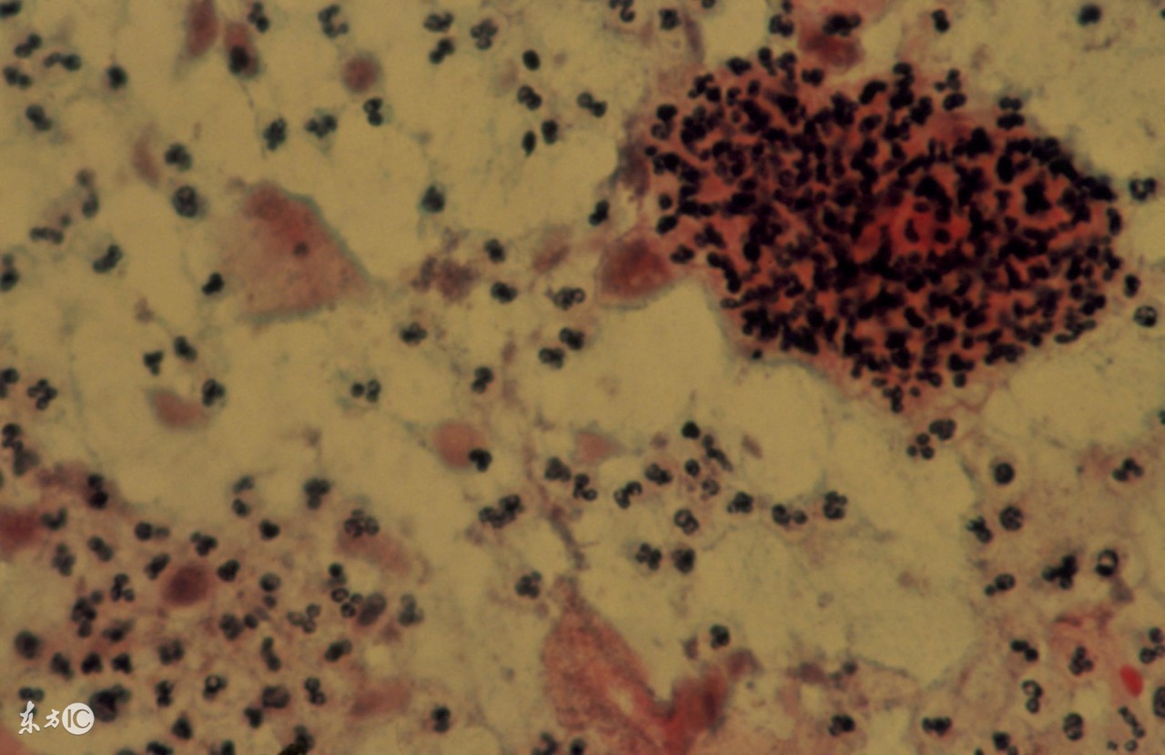 急性宫颈炎可以吃阿奇霉素吗,女性急性宫颈炎的表现