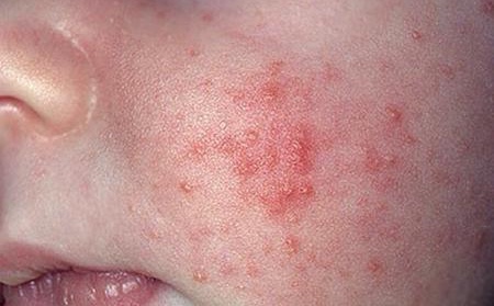 婴儿脸上疹子,婴儿疹子
