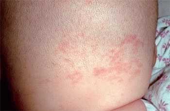 孩子出生脸上为什么有胎记,剖腹产出来宝宝脸上有红胎记