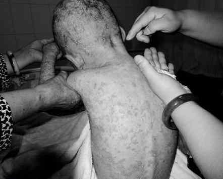 宝宝肤专家可以治疗湿疹吗,一岁半宝宝湿疹怎么治疗