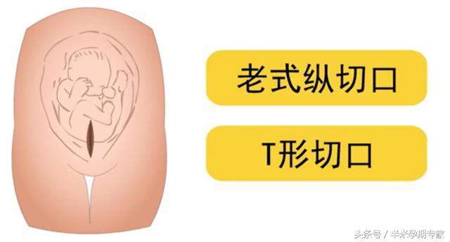 头胎剖宫产二胎可以是双胞胎吗,一胎剖宫产二胎见红后顺产