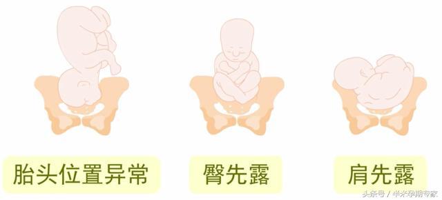 影响胎儿分娩的因素,护考影响分娩的因素