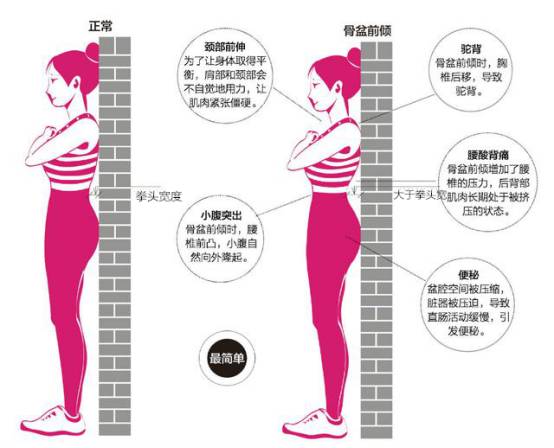 你的屁屁是真的蜜桃臀？还是骨盆前倾的伪翘臀？