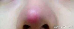 隆鼻后鼻子红肿怎么回事,隆鼻后鼻子肿胀是怎么回事