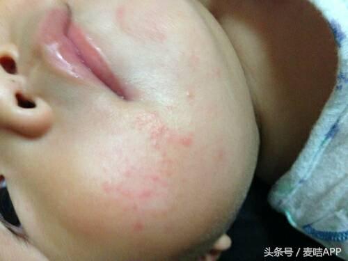 妈妈做对３件事，宝宝用多效修复凝胶湿疹不再来！