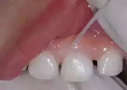 儿童牙齿黑乎乎的,孩子牙齿里面黑黑的怎么回事