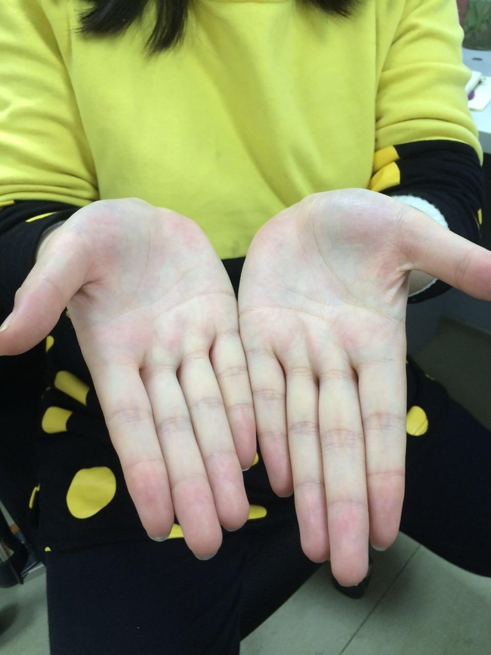 健康关注重点,哪些位置的痘不能随便乱挤