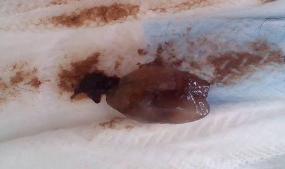 人流手术的真实经历,在医院做人流手术辞职