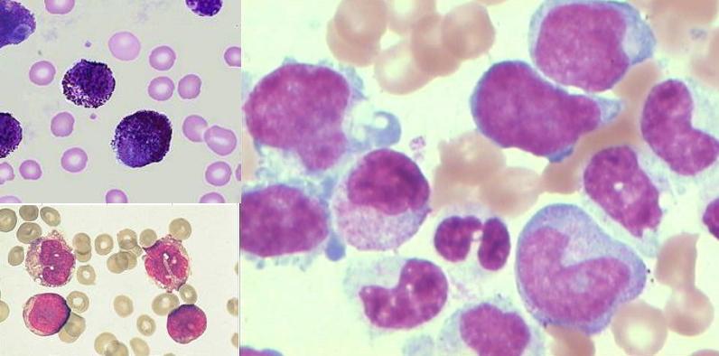 中医治疗白血病名医,中医对血液病的看法