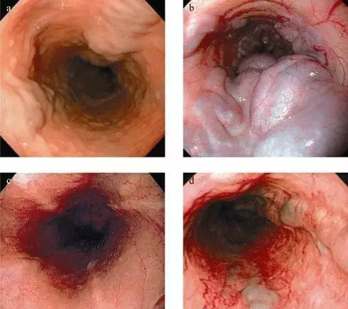 当心肝硬化晚期并发症！大吐血！附防治方案