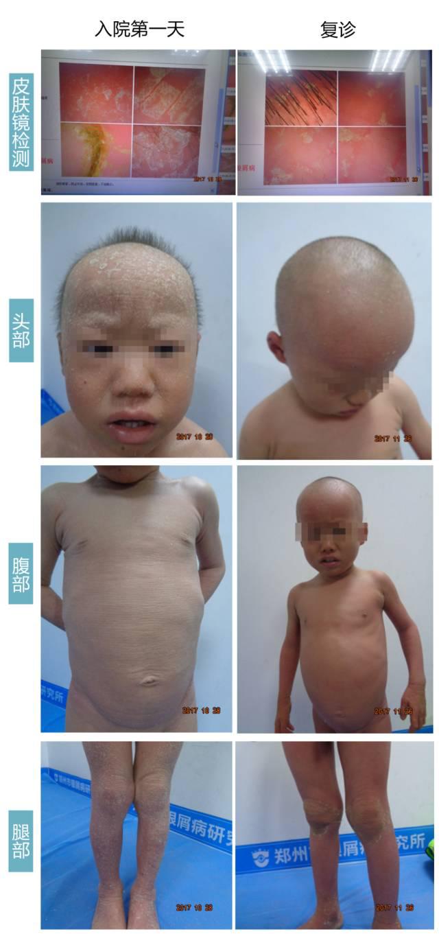 案例分享|四岁男童因误治变成沙皮人！