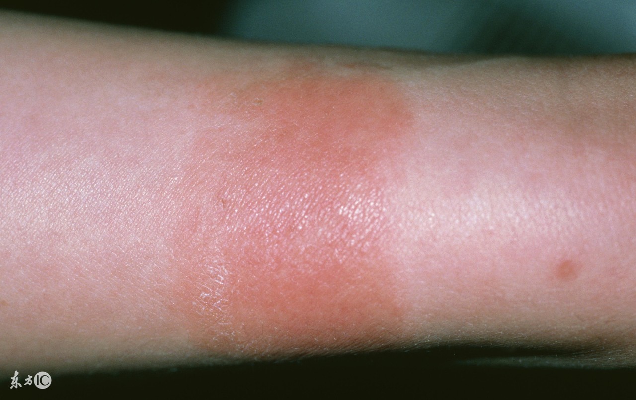 眼睑浮肿是什么原因引起的怎么办,眼睑浮肿是什么原因怎么办