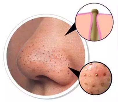 痘痘类皮肤的护理方法有哪些,痘痘肌肤的8个护理方式