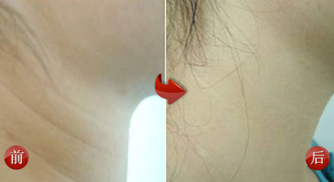 为什么会有颈纹颈纹很深怎么去除,产后颈纹很深怎么办如何消除颈纹