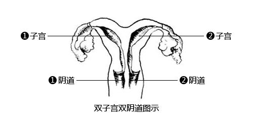 双子宫生子,双子宫怀孕生子危险吗