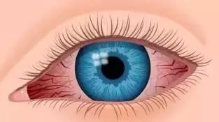 睡觉起来眼睛红血丝怎么回事,眼睛有红血丝是怎么回事如何解决