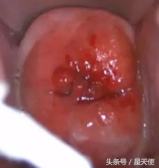宫颈癌有遗传的可能性吗,宫颈癌发病率最高的4个表现
