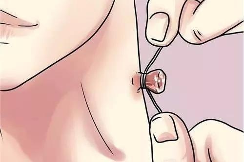 身体上长了好多小揪揪,身上有小揪揪怎么回事