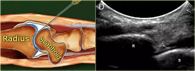超声引导穿刺和介入穿刺的优缺点,关节超声引导