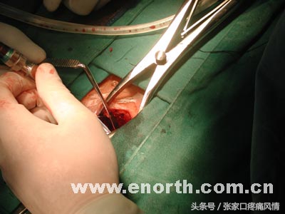 丹鹿通督丸治腰间盘突出效果好吗,治疗腰间盘突出的膏药哪个牌子好