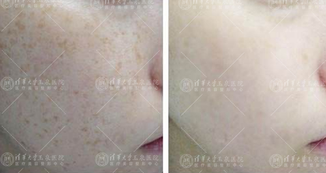 去看皮肤科治疗雀斑问什么问题,去医院什么科治疗雀斑