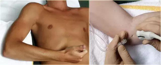 超声引导穿刺和介入穿刺的优缺点,关节超声引导