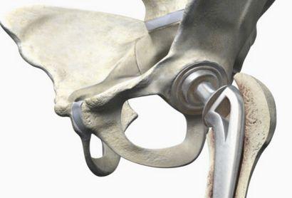 股骨头坏死，用药为何要讲“疗程”？