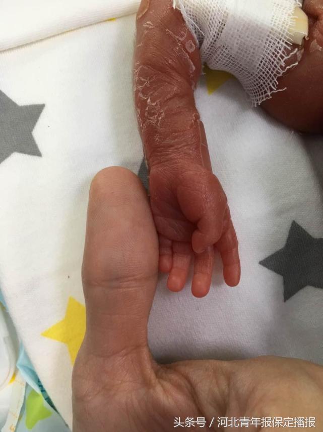 保定新生婴儿出生,生长受限的早产儿刚出生的照片