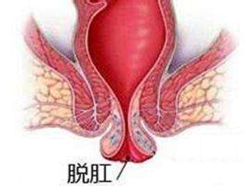 你有痔疮吗该怎么回答,你有痔疮