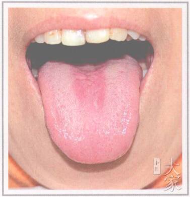 舌诊剥苔,小儿怎样看舌苔辨病症