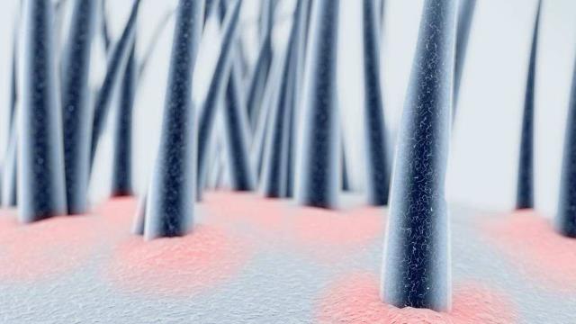 发红发痒还有皮屑是脂溢性皮炎吗,皮肤发红痒脂溢性皮炎