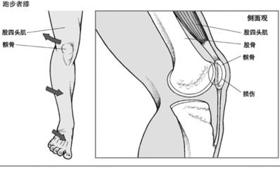 髌骨软化会膝前疼吗,膝前髌骨疼