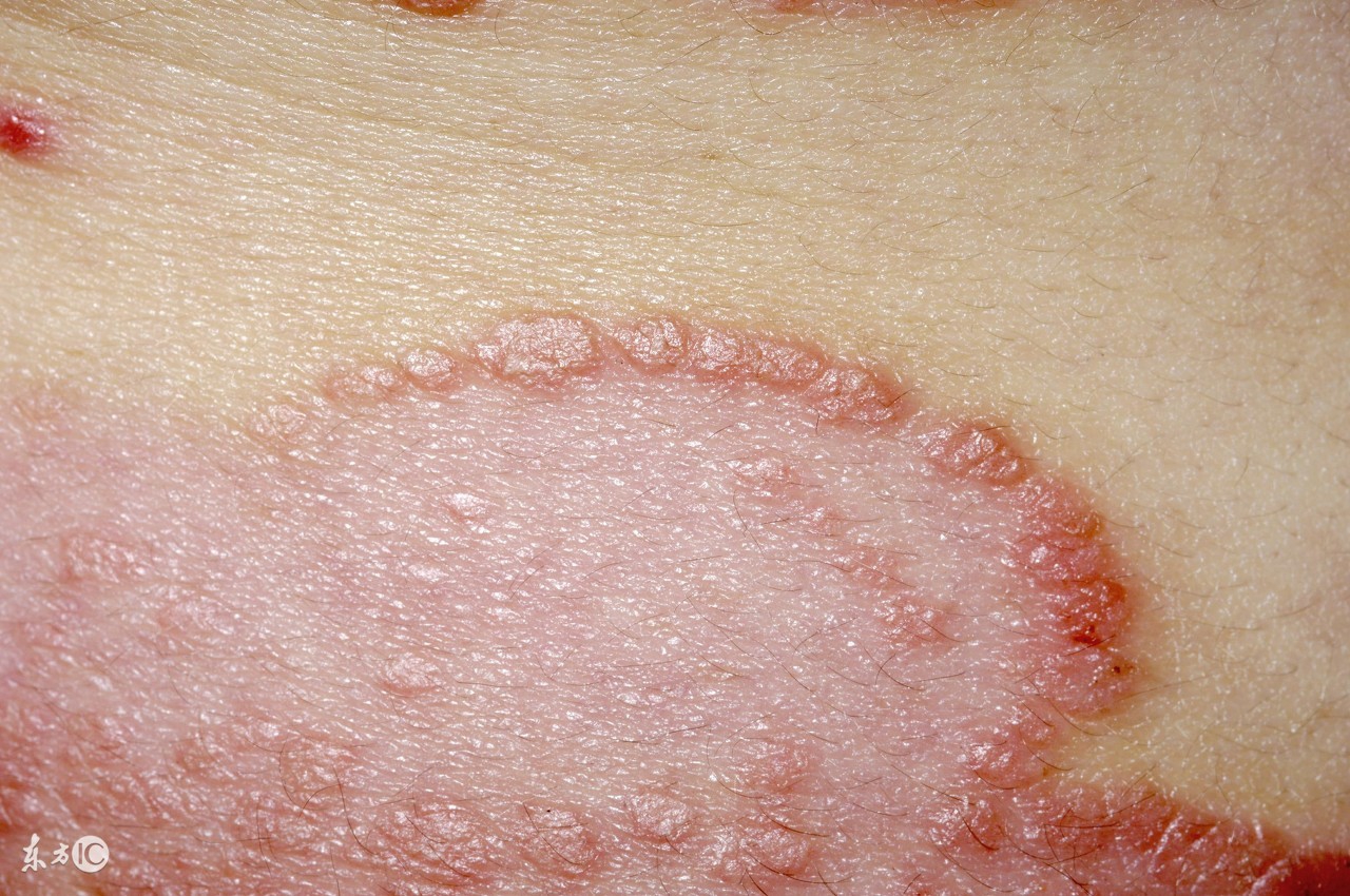 银屑病药外用注意事项,治疗银屑病这5个方面要注意