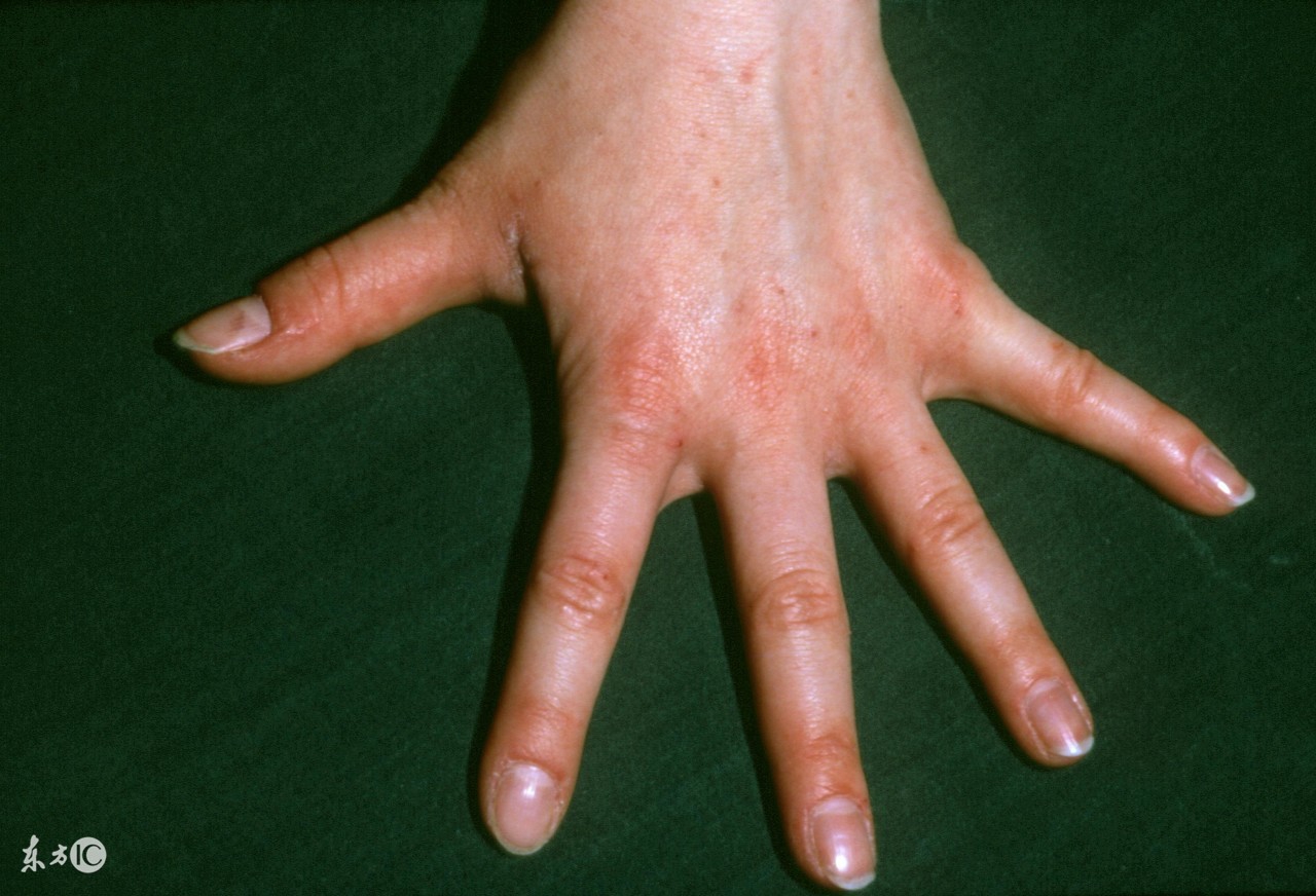 草鱼疥疮病的防治,疥疮防治意见