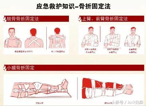 急救骨折固定方法,骨折病人现场急救护理措施