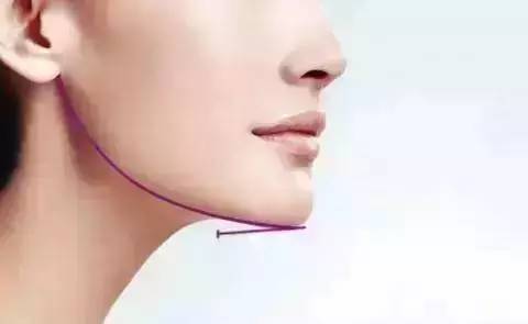 丰下巴用玻尿酸好还是自体脂肪好,玻尿酸丰下巴后要注意哪些问题