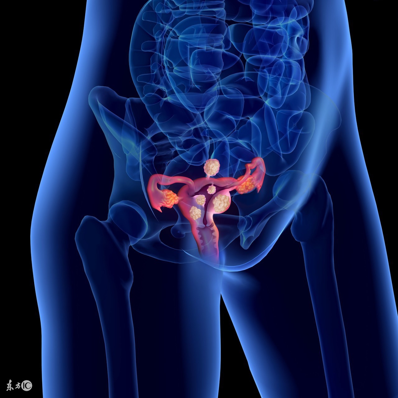 内膜增厚宫腔镜刮宫后注意事项,子宫内膜增厚刮宫后注意事项