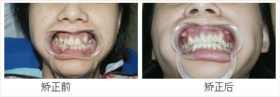 有虫牙可以正畸吗,虎牙齿可以矫正吗