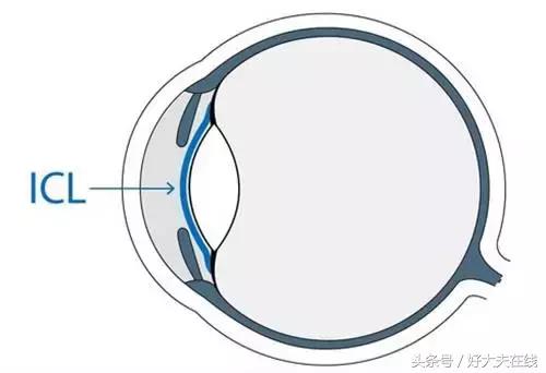 老年人做近视眼手术靠谱吗,4种近视手术哪种好
