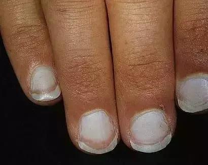 指甲出现哪些症状是有问题的,指甲上有皱纹有什么信号求救