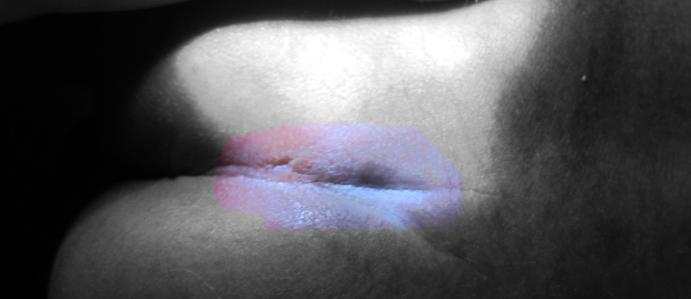 儿童12岁隐性脊柱裂尿床能自愈吗,儿童骶1椎体隐性脊柱裂手术