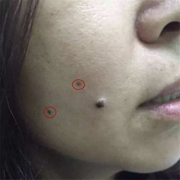 乳房上长的痣可以用激光点掉吗,什么样的痣适合激光点痣