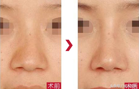 在家如何矫正歪鼻梁,歪鼻梁怎么修容