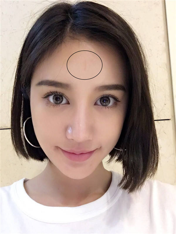 轻松修复痘印告别痘痘肌,有效快速祛痘印