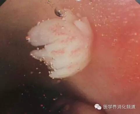 食管良性肿瘤科普视频,食管乳头状瘤和增生区别