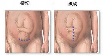 对于选择剖腹产的孕妈妈而言,到底剖腹产是怎样的?(图解)
