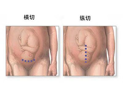 剖腹产全过程,剖腹产20天伤口真实照片