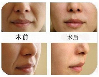 有一种增龄神器叫法令纹